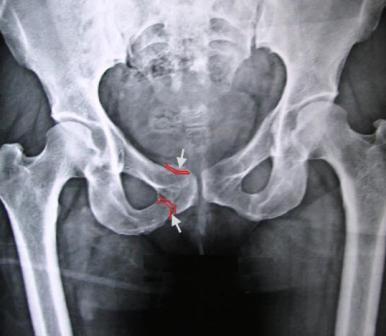 pelvic fracture x-ray
